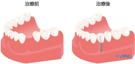 1本の歯が欠損した場合　インプラントの場合